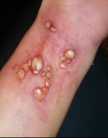 boil wounds prosthetic