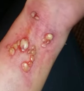 boil wounds prosthetic