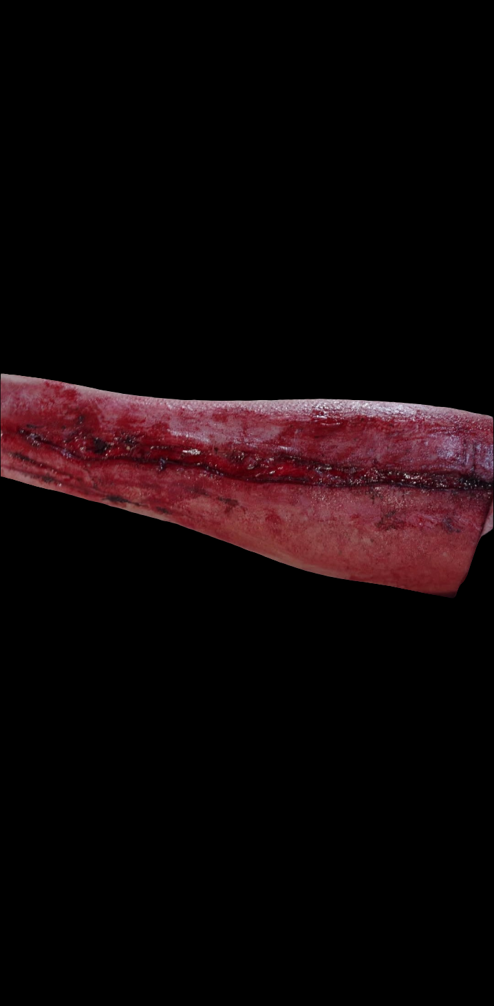 2 LARGE SLASH INJURY