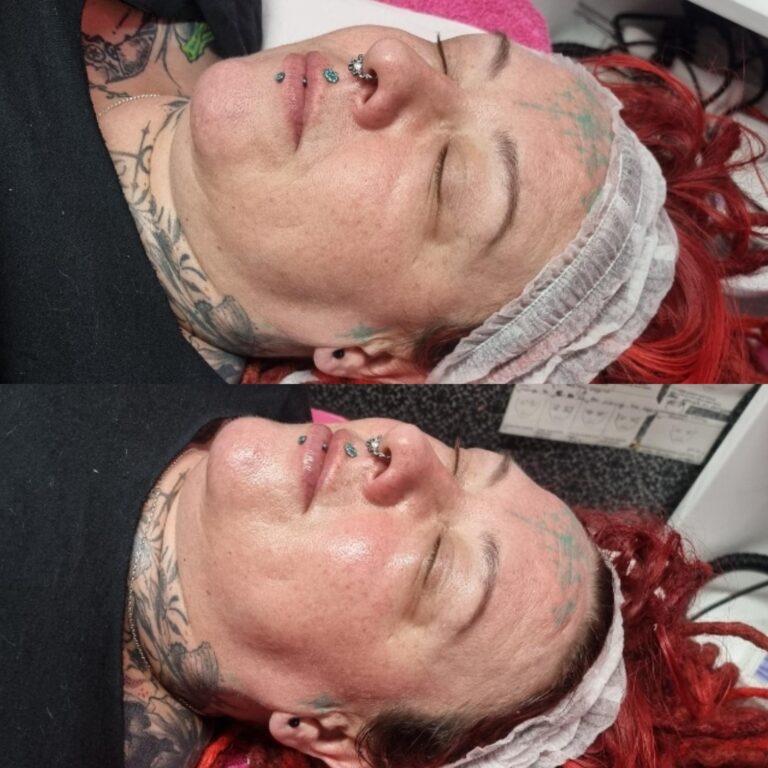 chemical peel accredited course Leicester facial