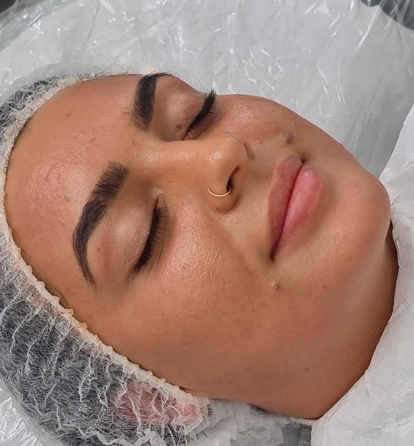 Leicester facial/ skincare packages/ micro needling/ bio peeling/ radio frequency