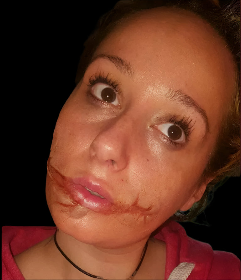 Chelsea smile joker smile slash wound prosthetic