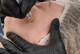microneedling course workshop microdermabrasion