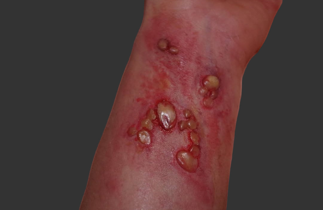 boil prosthetic injury wound silicone