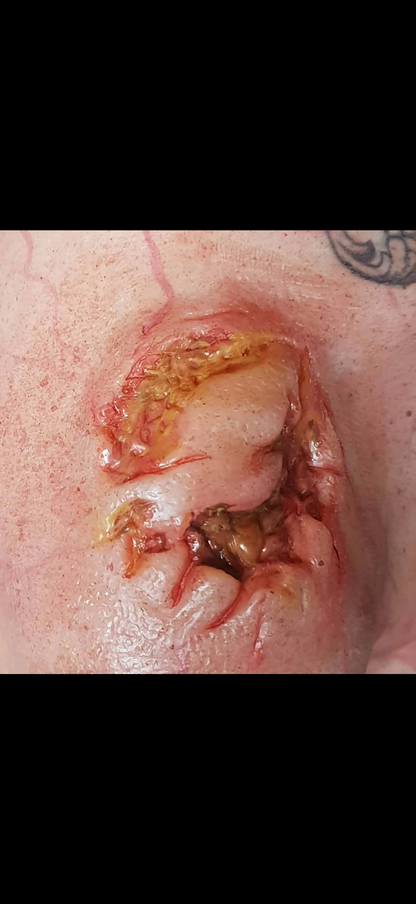 Zombie bite, wound, flesh wound