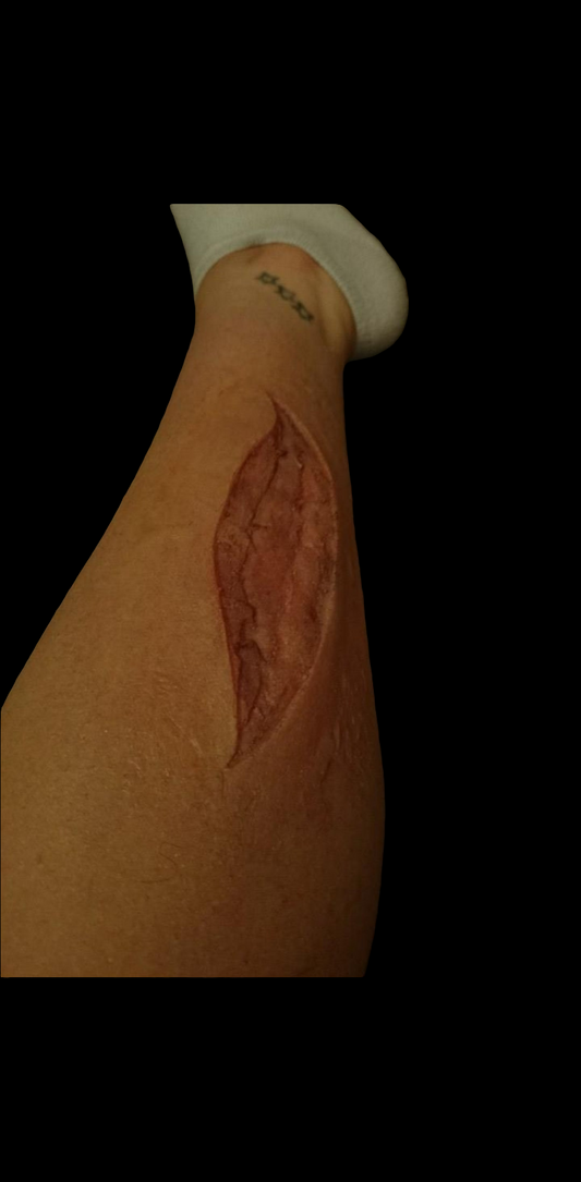 2 LARGE SLASH INJURY