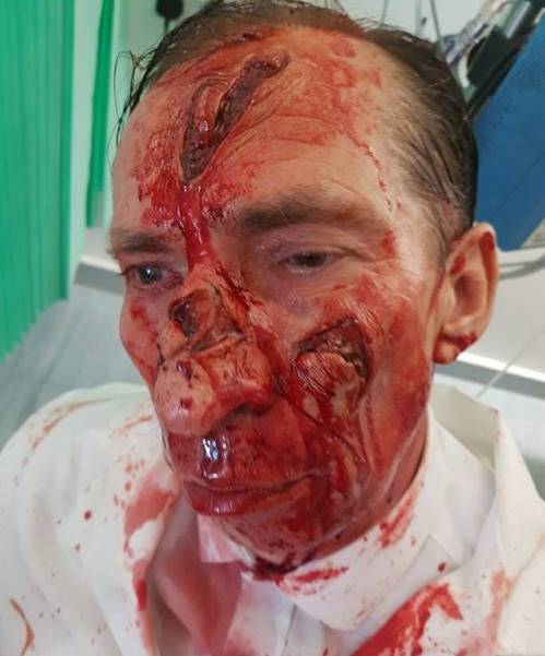 extreme wound injury Realistic prosthetic application by Leicester special effects makeup artist