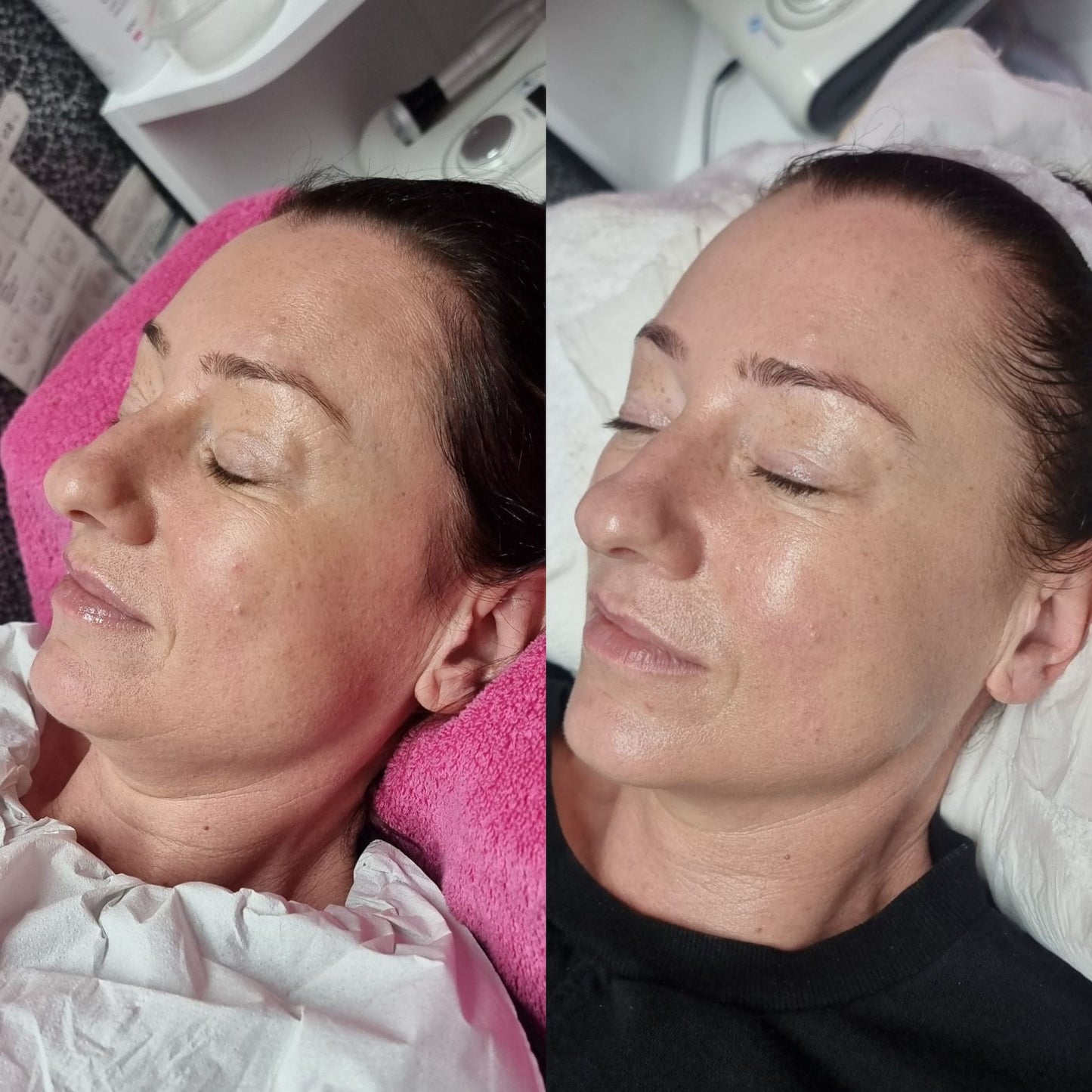 Leicester facial/ skincare packages/ micro needling/ bio peeling/ radio frequency 