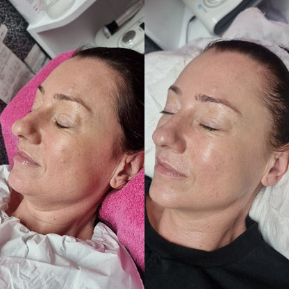 Leicester facial/ skincare packages/ micro needling/ bio peeling/ radio frequency 