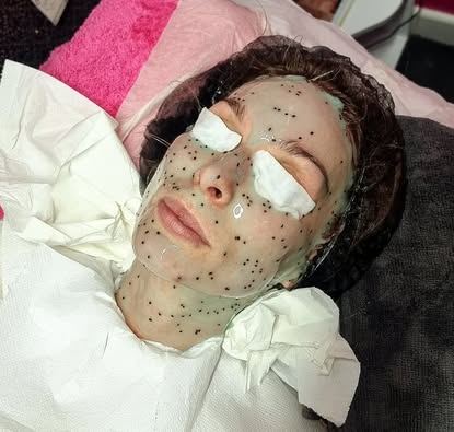 Leicester facial/ skincare packages/ micro needling/ bio peeling/ radio frequency 