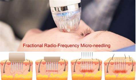 rf fractional needling beauty course accredited course