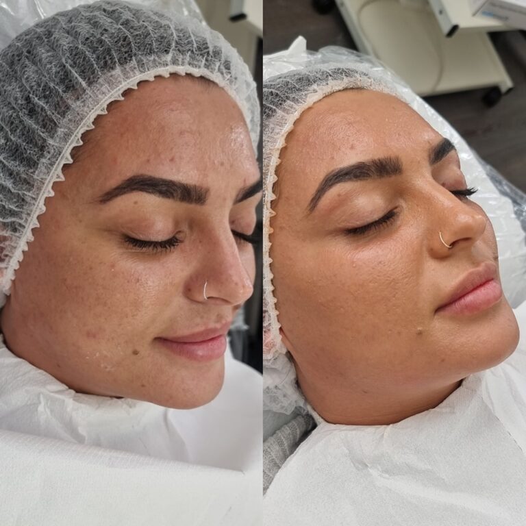 microneedling course workshop bb glow