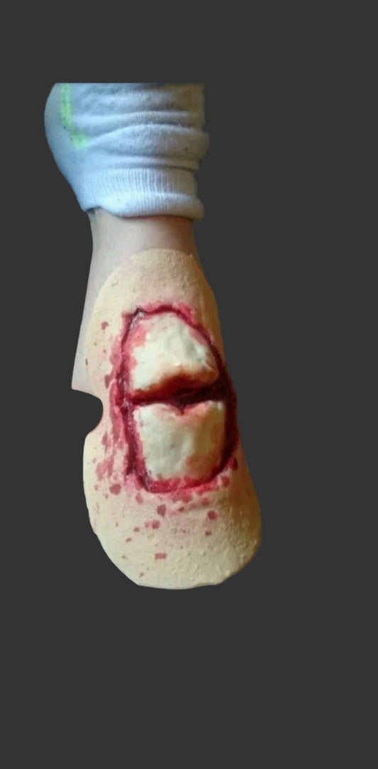 BROKEN BONE