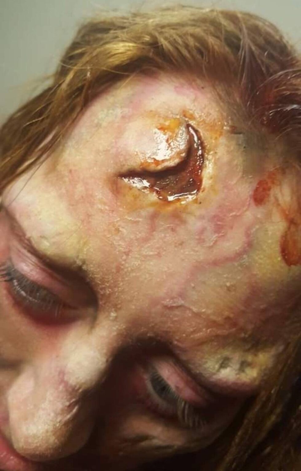 small injury prosthetics wounds