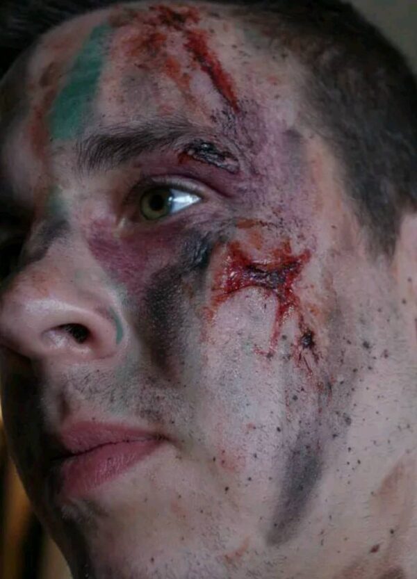 small stab injury prosthetics wounds